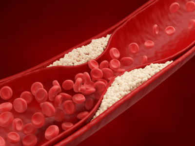 JOURNAL CLUB: ANTICOAGULATION